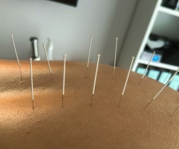 Suche igłowanie z terapią blizny - kurs